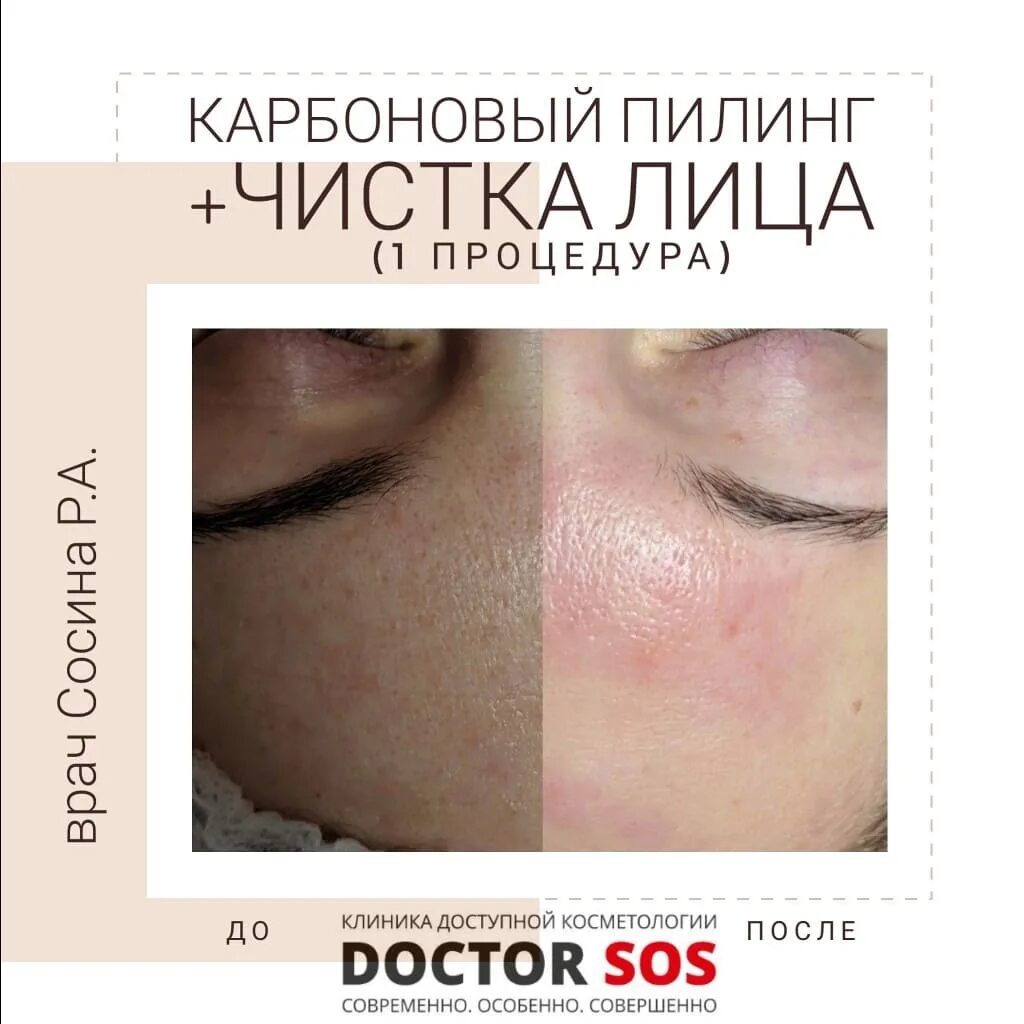 Карбоновый пилинг отзывы фото до и после Чистка с карбоновым пилингом Клиника Инновационной Косметологии DoctorSOS