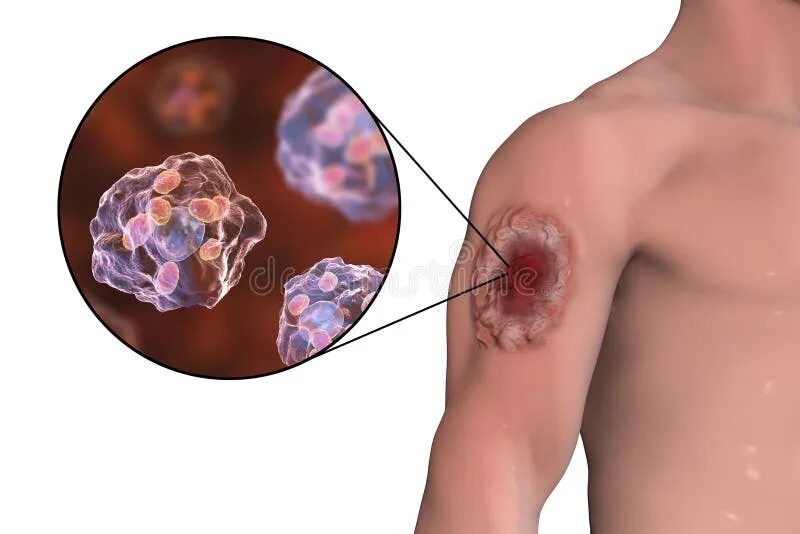 Карбункул при сибирской язве фото Cutaneous Leishmaniasis Ulcer and Close-up View of Leishmania Amastigotes Stock 