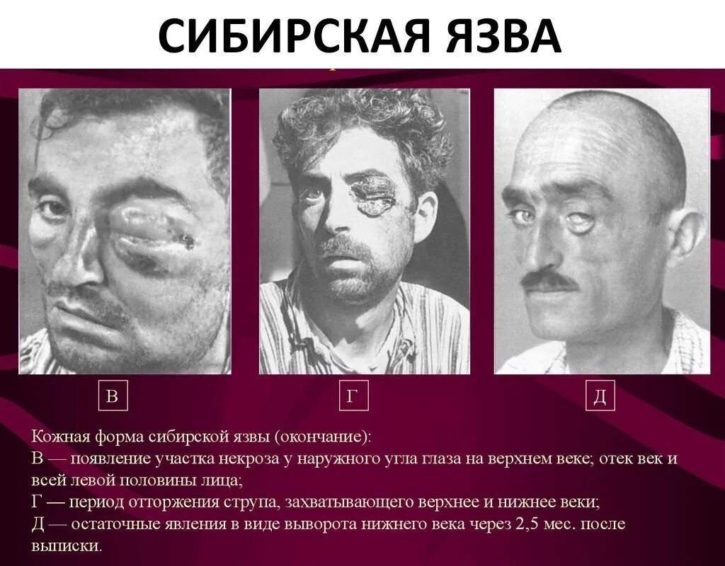 Карбункул при сибирской язве фото ПАМЯТКА ДЛЯ НАСЕЛЕНИЯ МЕРОПРИЯТИЯ ПО ПРОФИЛАКТИКЕ СИБИРСКОЙ ЯЗВЫ СИБИРСКАЯ ЯЗВА 