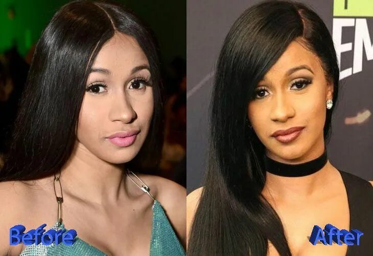 Карди би фото до и после пластики Cardi B Plastic Surgery: A New Look For A New Life #plasticsurgery Plastic surge