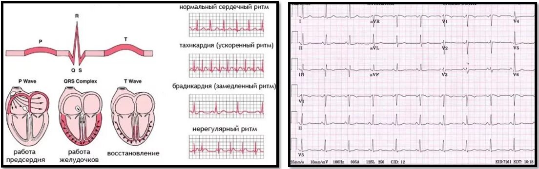 Кардиограмма сердца фото как делают Анализы для спортсмена: чекап для фитнеса и бодибилдинга