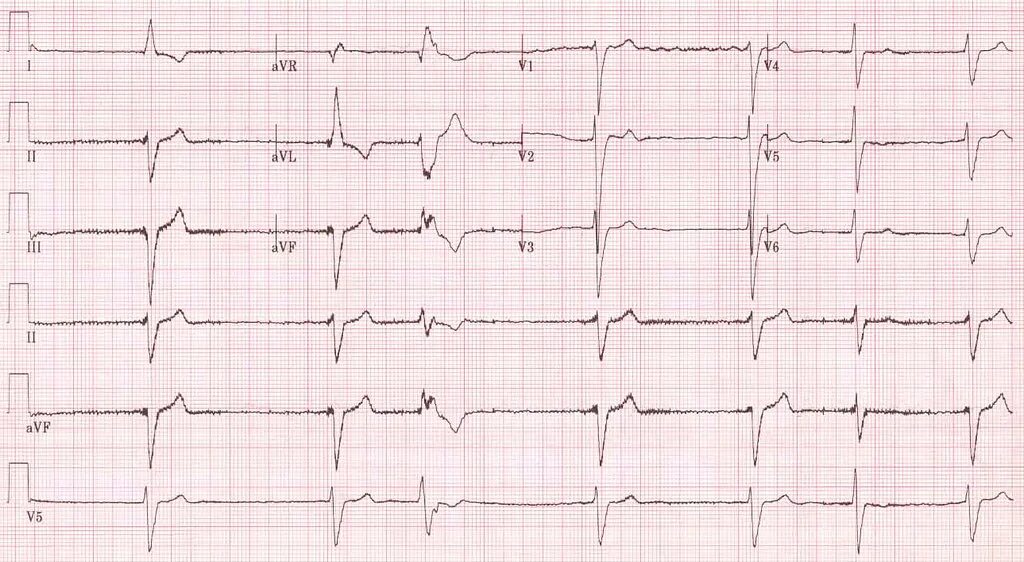 Кардиограмма сердца фото как делают AF with slow ventricular response AF with slow ventricular. Flickr