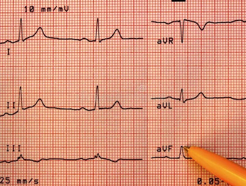 Кардиограмма сердца фото как делают An Abnormal Electrocardiogram Result Paper with a Little Yellow Candy Heart Stoc