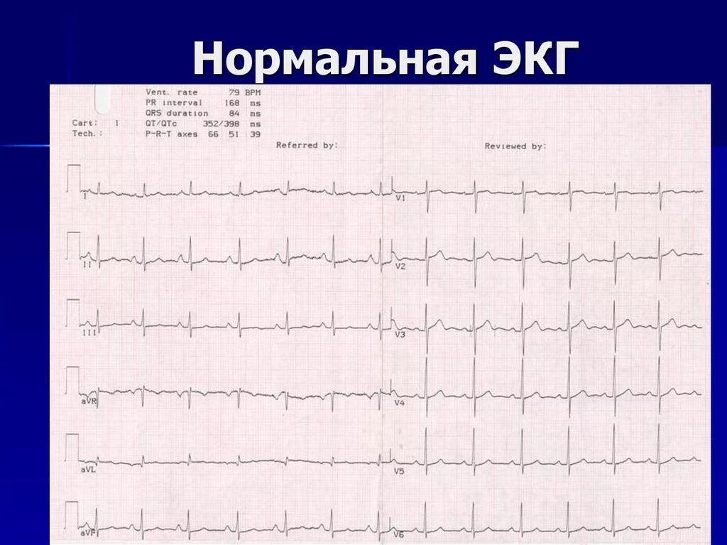 Кардиограмма сердца норма фото Патология экг в картинках