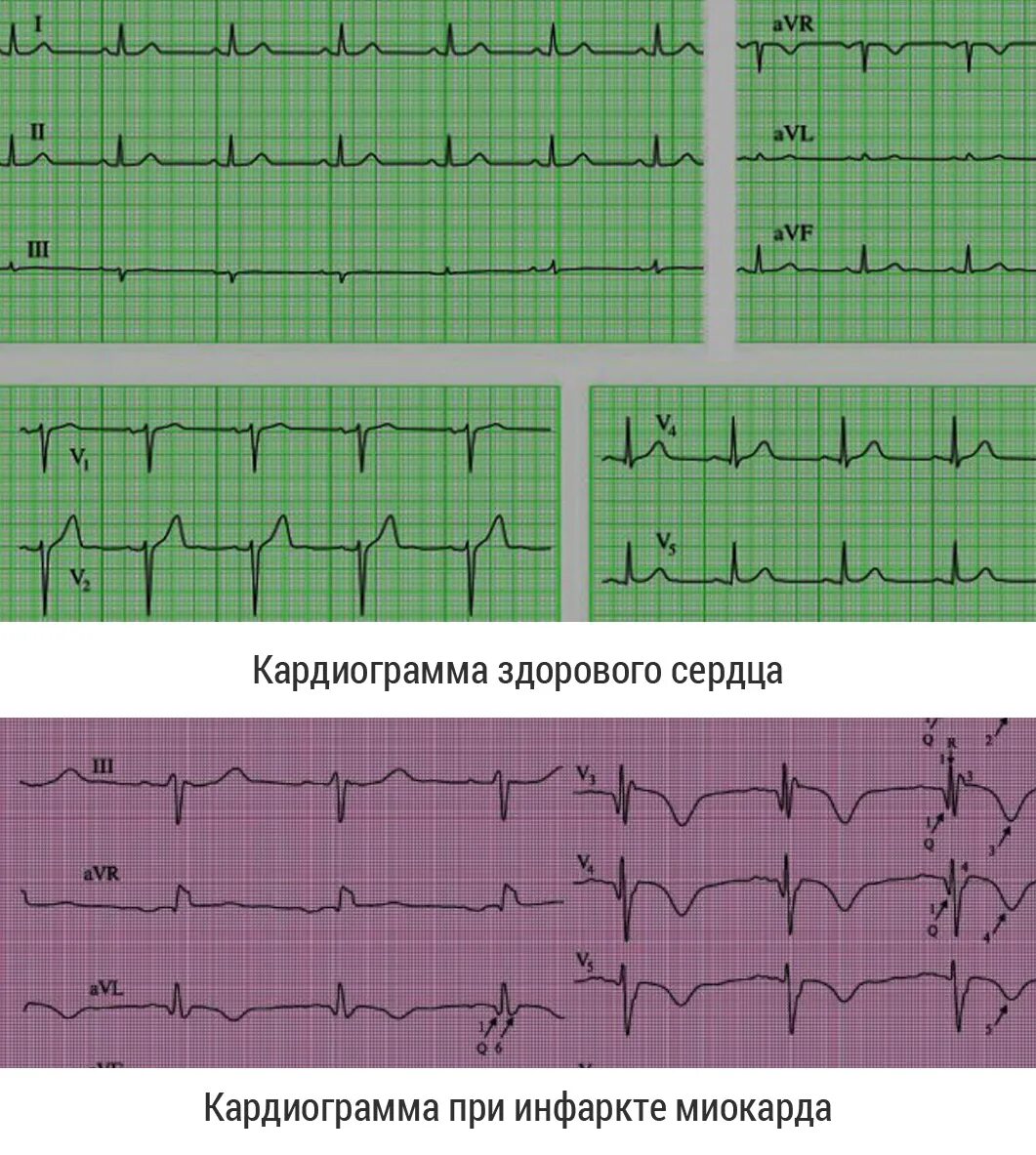 Кардиограмма сердца нормальная фото как выглядит Ишемическая болезнь сердца: причины, симптомы болезни в Москве