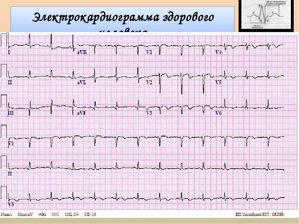 Кардиограмма сердца нормальная фото как выглядит Найти экг по картинке