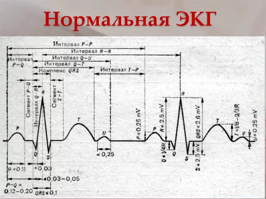 Кардиограмма сердца нормальная фото как выглядит Рисунок кардиограммы здорового человека