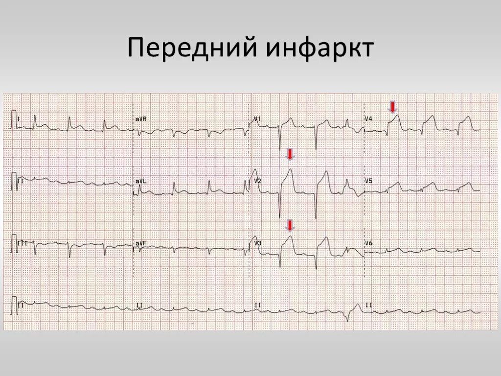 Кардиограмма сердца при инфаркте фото Презентация "ЭКГ-диагностика при подозрении на инфаркт миокарда" - скачать проек