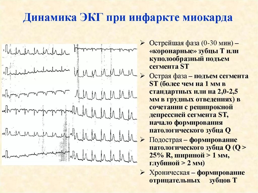 Кардиограмма сердца при инфаркте фото расшифровка Покажет экг после