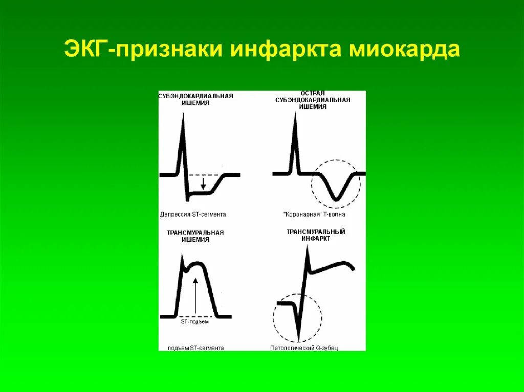 Кардиограмма сердца при инфаркте фото расшифровка Картинки ЭКГ ПРИ ИНФАРКТЕ МИОКАРДА