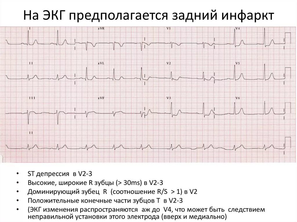 Кардиограмма сердца при инфаркте фото расшифровка Экг после: найдено 85 изображений
