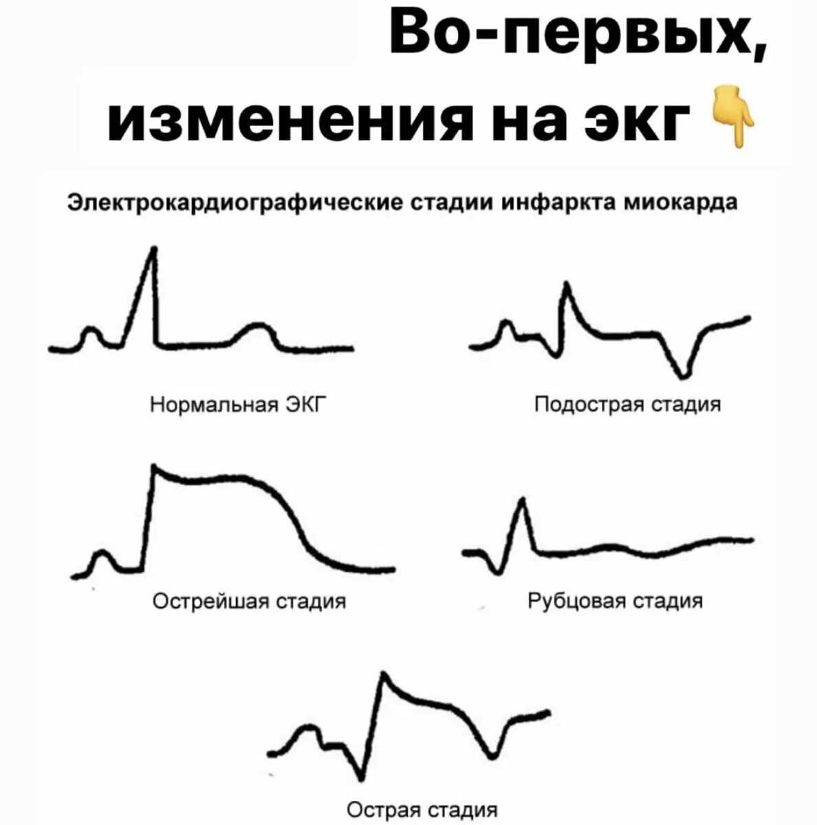 Кардиограмма сердца при инфаркте фото расшифровка Инфаркт: почему иногда фатален, а иногда случайно находят при диспансеризации? Д