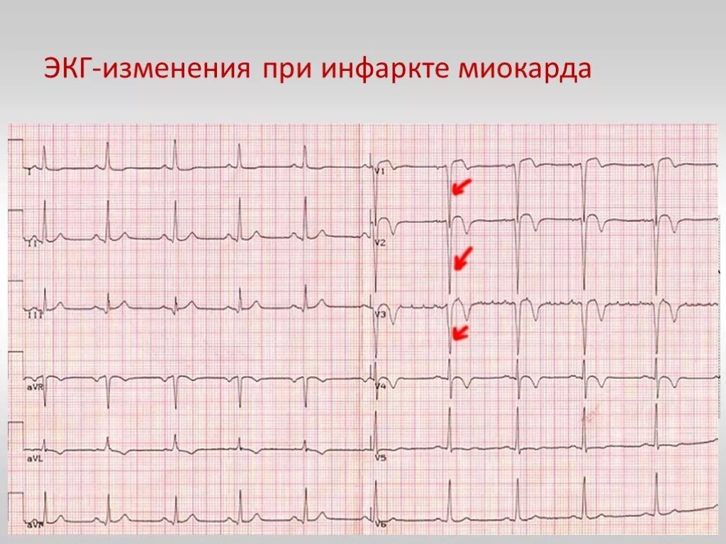 Кардиограмма сердца при инфаркте фото расшифровка Покажет экг после - найдено 86 картинок