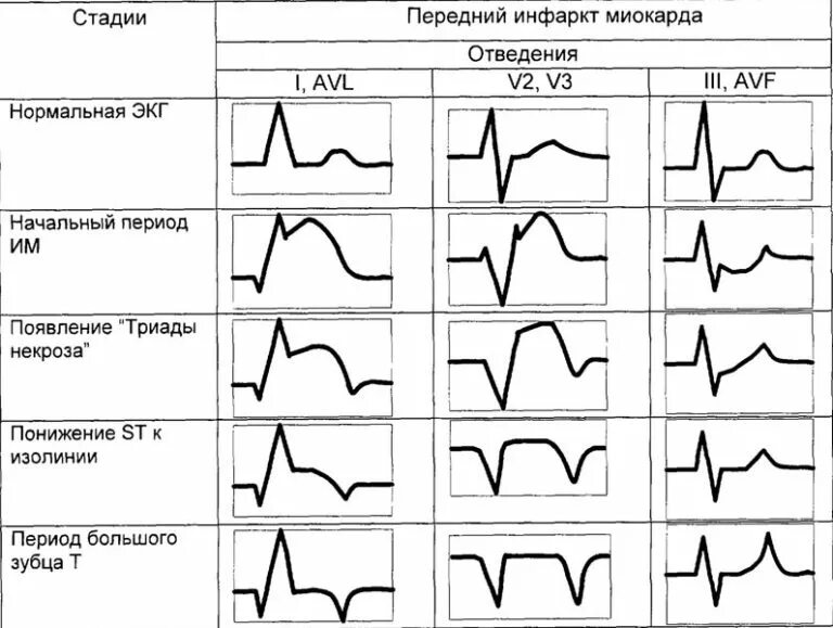 Кардиограмма сердца при инфаркте фото расшифровка Динамика инфаркта миокарда на ЭКГ