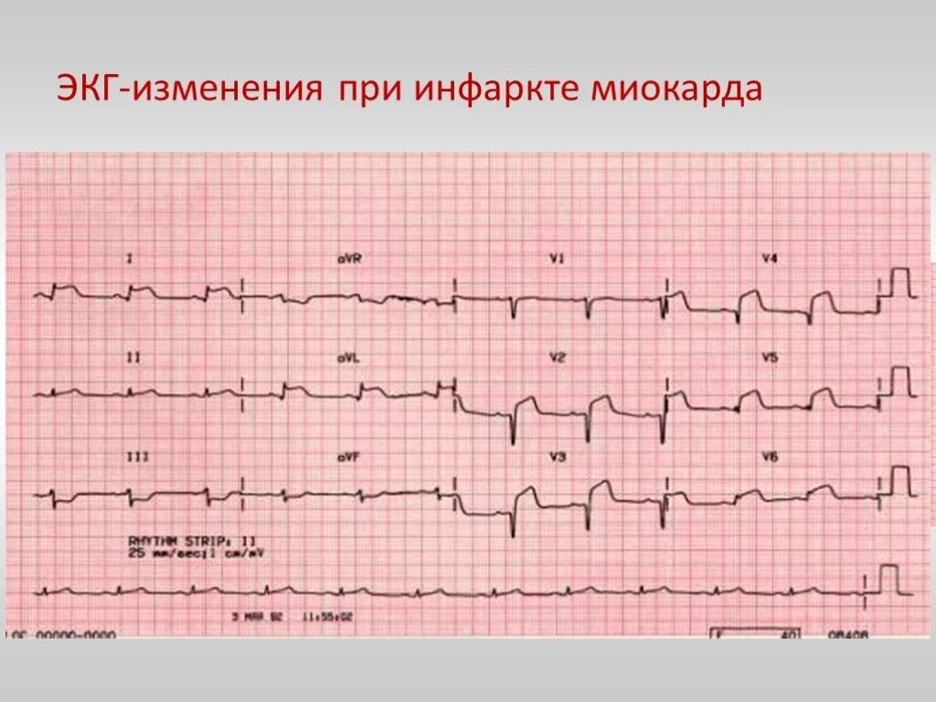 Кардиограмма сердца при инфаркте фото расшифровка Покажет экг после