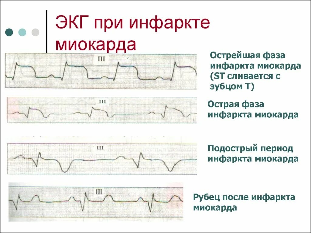 Кардиограмма сердца при инфаркте фото расшифровка Покажет экг после
