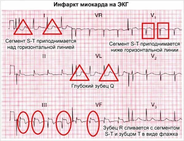 Кардиограмма сердца при инфаркте фото расшифровка Инфаркт миокарда (сердечный приступ): причины, симптомы и лечение в статье аритм
