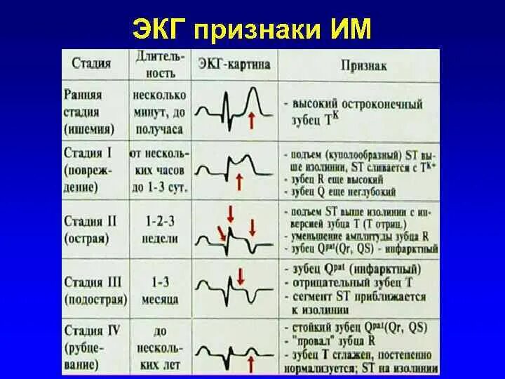 Кардиограмма сердца при инфаркте миокарда фото Картинки ЭКГ ПРИЗНАКИ НЕКРОЗА