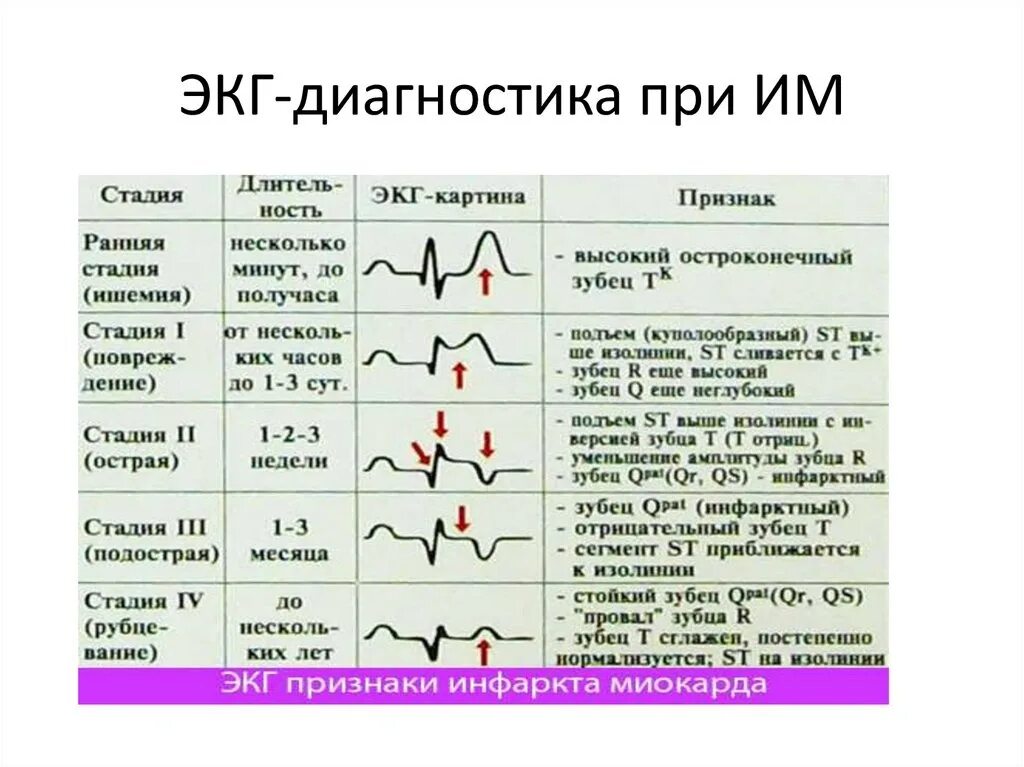 Кардиограмма сердца при инфаркте миокарда фото Картинки ЭКГ ПРИЗНАКОМ КРУПНООЧАГОВОГО ИНФАРКТА МИОКАРДА ЯВЛЯЕТСЯ