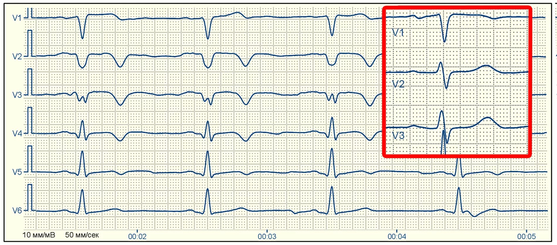 Кардиограмма сердца при инфаркте миокарда фото Рубцовые изменения - E-Cardio