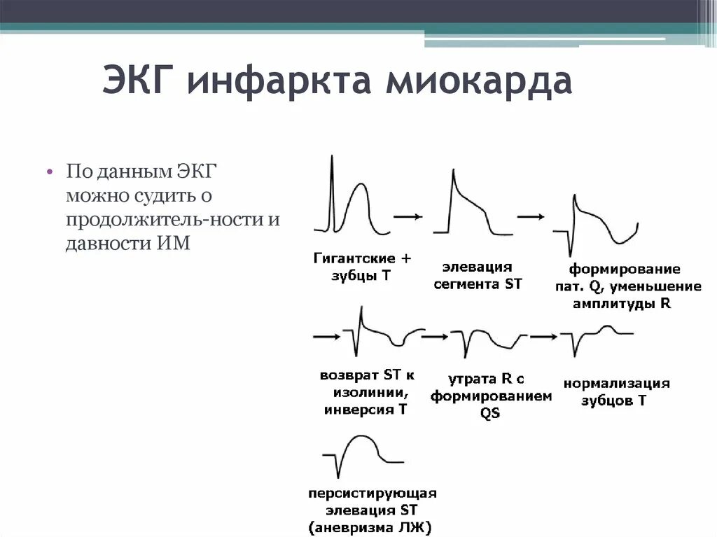 Кардиограмма сердца при инфаркте миокарда фото Картинки ЭКГ ПРИЗНАКИ НЕКРОЗА
