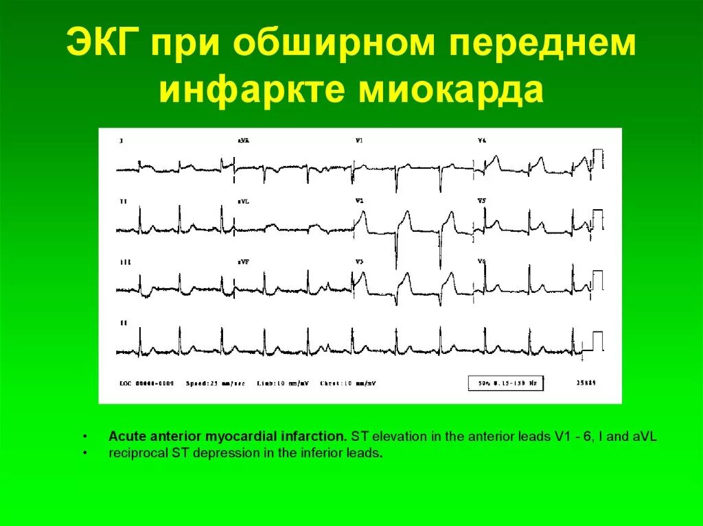 Кардиограмма сердца при инфаркте миокарда фото Покажет экг после