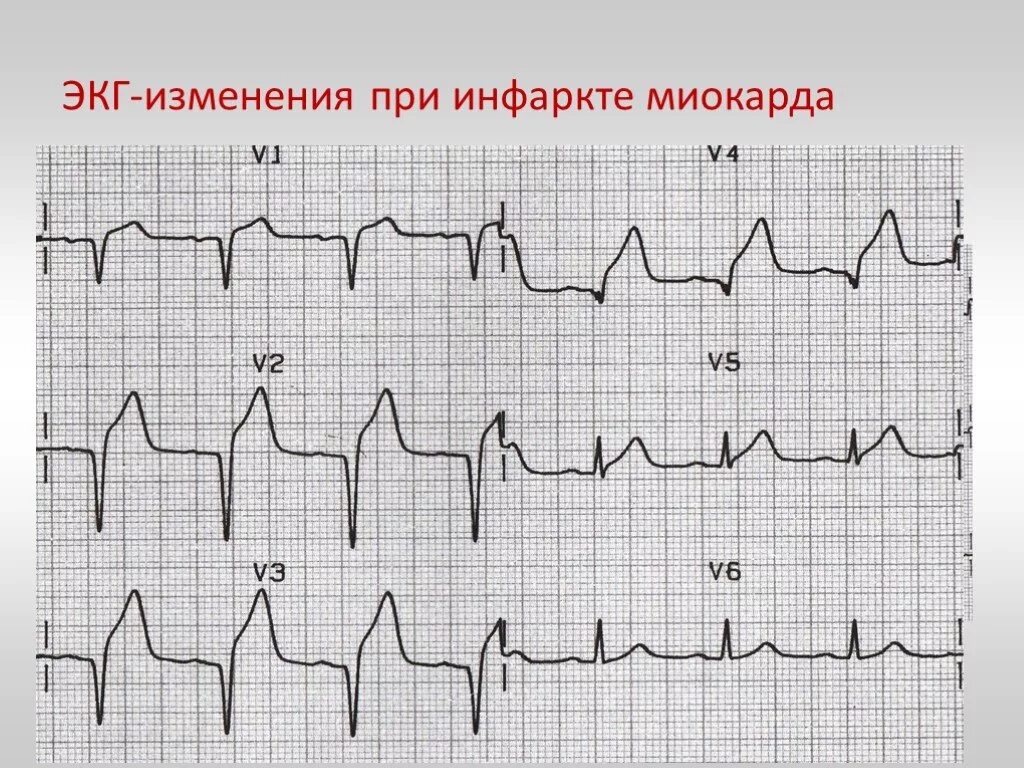 Кардиограмма сердца при инфаркте миокарда фото Презентация "ЭКГ-диагностика при подозрении на инфаркт миокарда" - скачать проек