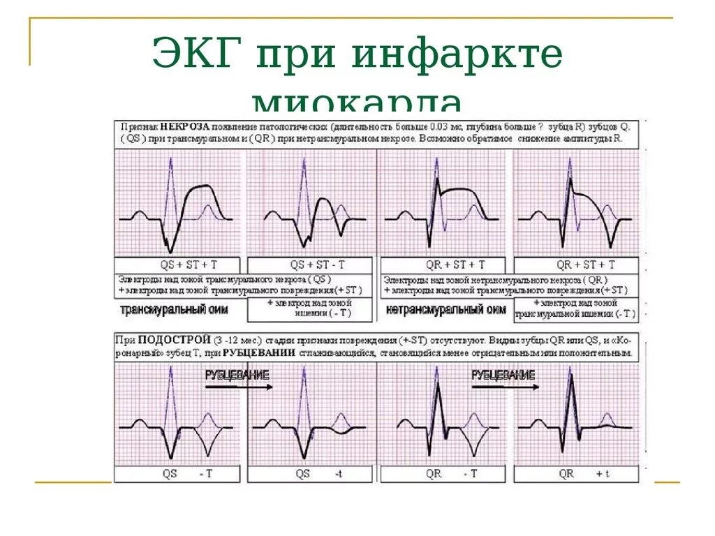 Кардиограмма сердца при инфаркте миокарда фото Нижний инфаркт экг признаки