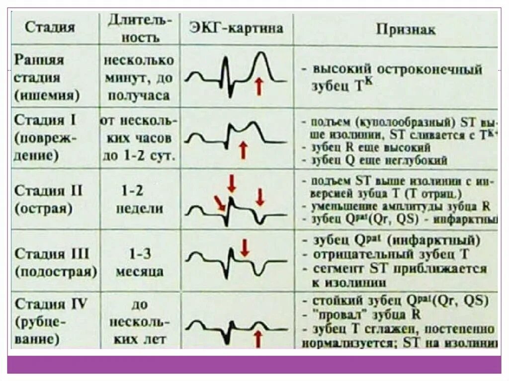 Кардиограмма сердца при инфаркте миокарда фото Стадии инфаркта на экг