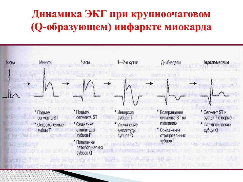 Кардиограмма сердца при инфаркте миокарда фото Картинки ХАРАКТЕРНЫЕ ИЗМЕНЕНИЯ ЭКГ