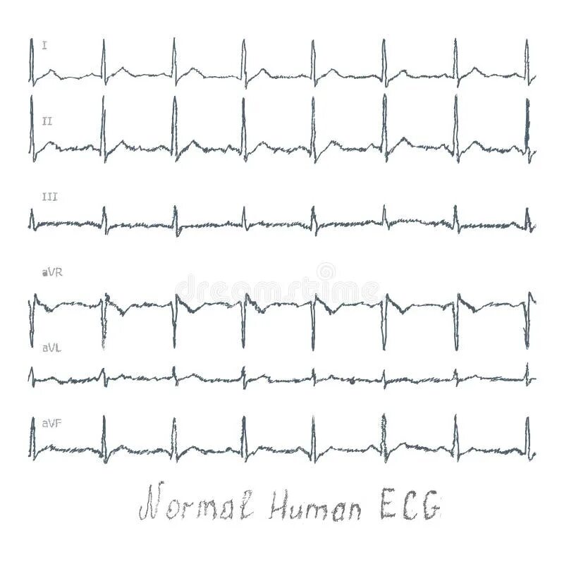 Кардиограмма сердца здорового человека фото Normal ECG Human Illustration Stock Illustration - Illustration of design, heart