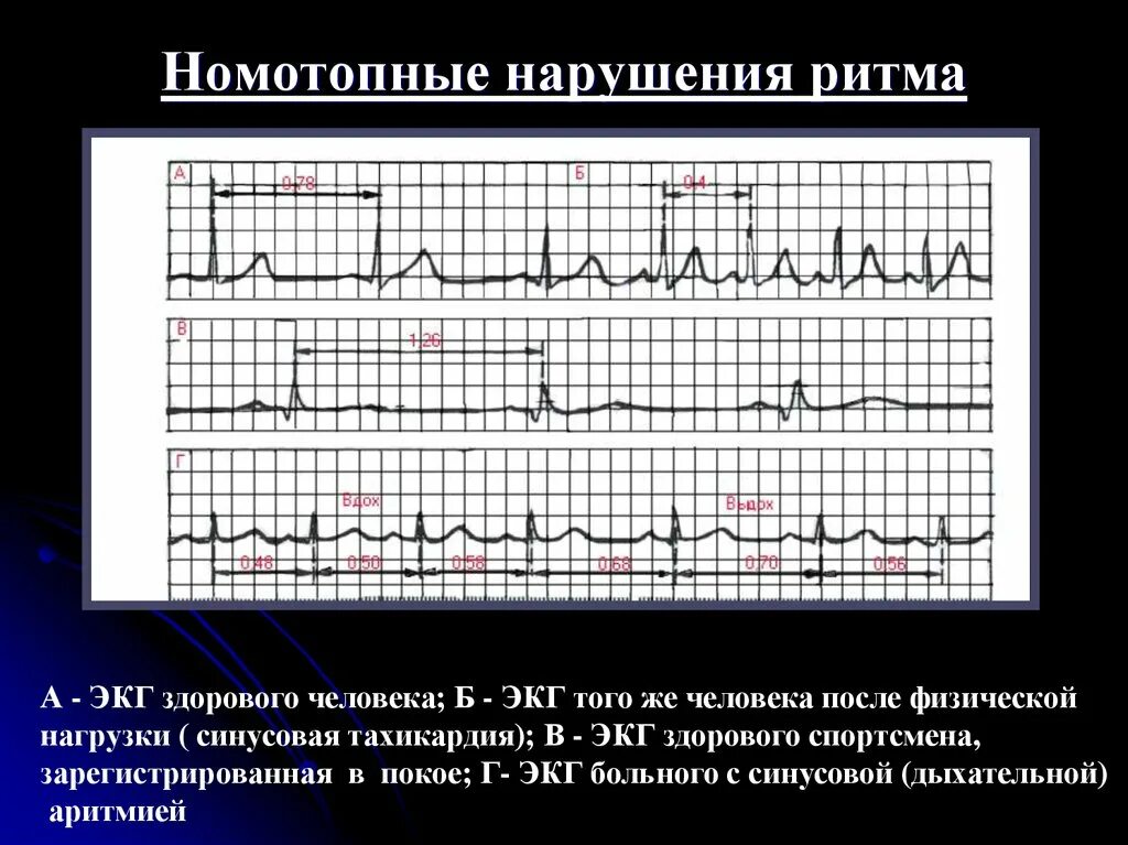 Кардиограмма сердца здорового человека фото и описание Экг б: найдено 83 изображений