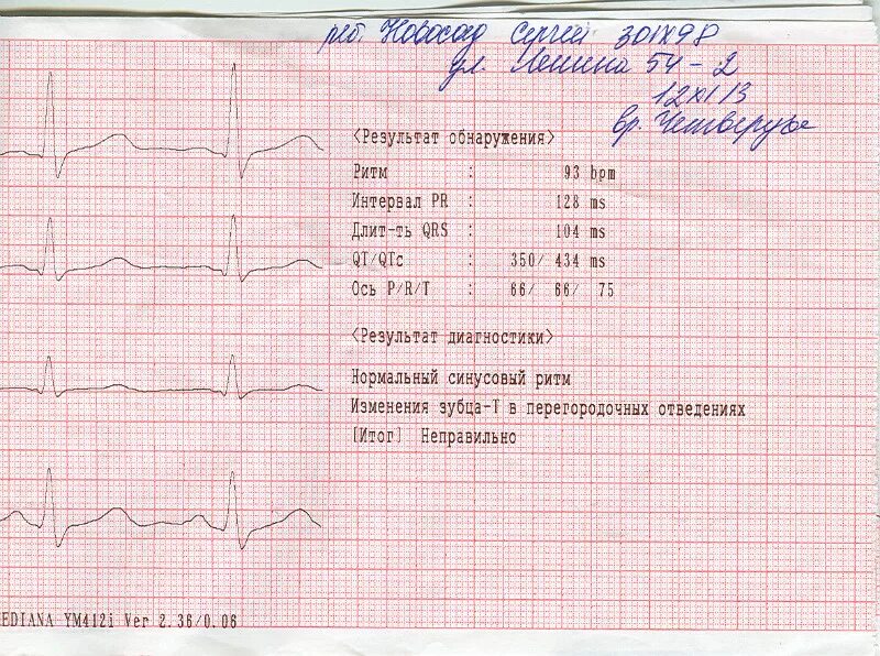 Кардиограмма сердца здорового человека фото и описание Рисунок кардиограммы здорового человека