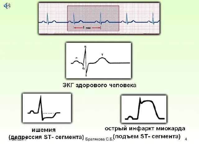 Кардиограмма сердца здорового человека фото и описание Тема "Гигиена сердечно-сосудистой системы"