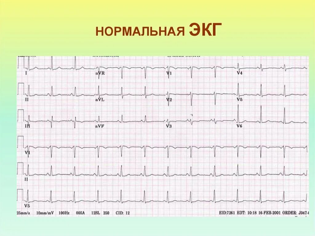 Кардиограмма сердца здорового человека фото и описание Патология экг в картинках