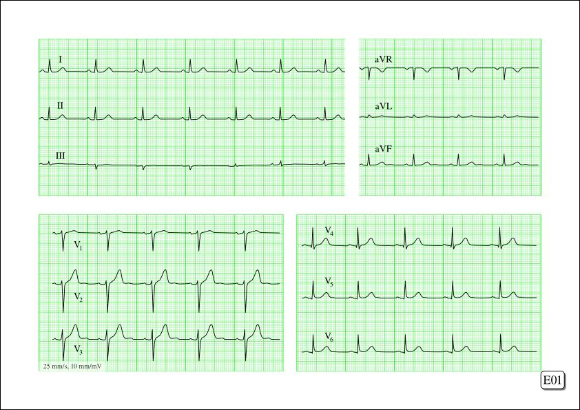Кардиограмма сердца здорового человека фото и описание Creation of an ECG workbook with Scribus