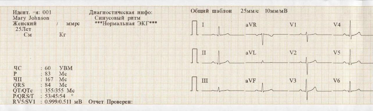 Кардиограмма сердца здорового человека фото и описание КАРДИОГРАФЫ.РФ :: Описание электрокардиографа Эдан SE-301
