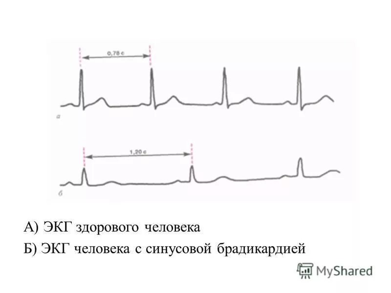 Кардиограмма сердца здорового человека фото и описание Рисунок кардиограммы здорового человека