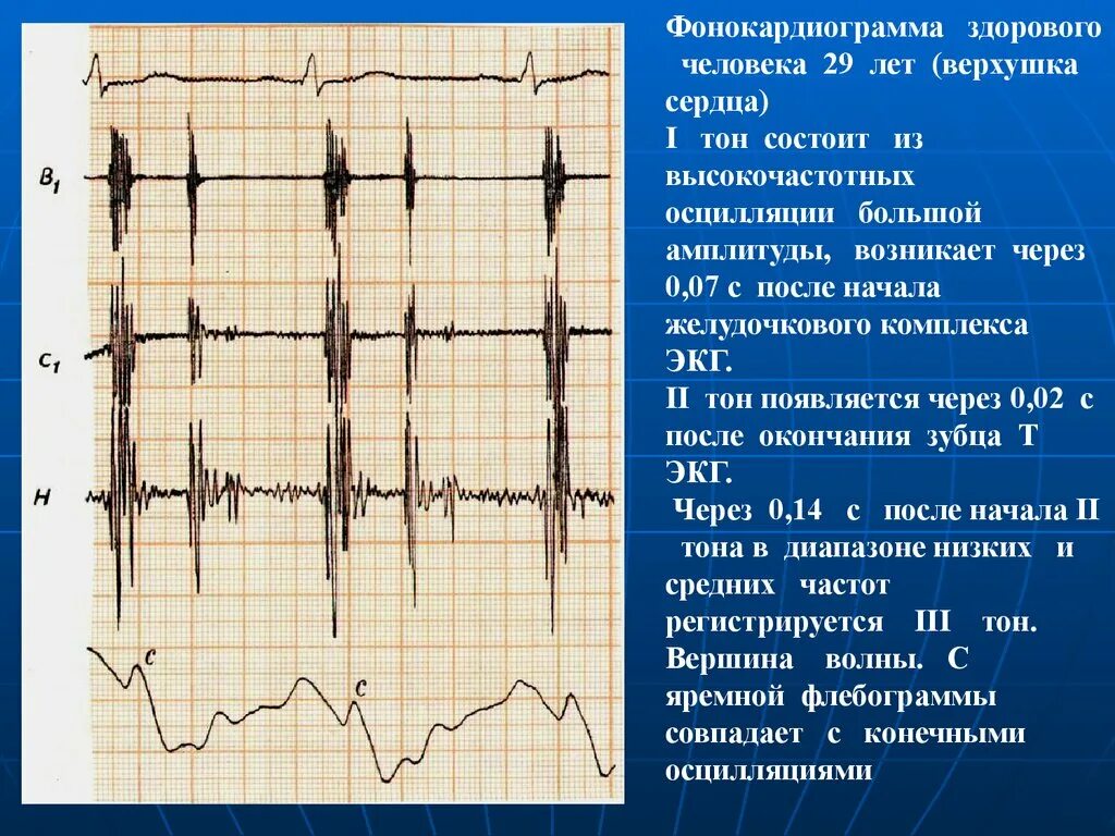 Кардиограмма сердца здорового человека фото и описание Картинки ЭКГ СНИМКИ