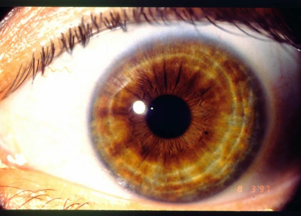 Карие глаза фото радужки Iridology and Nutrition Research
