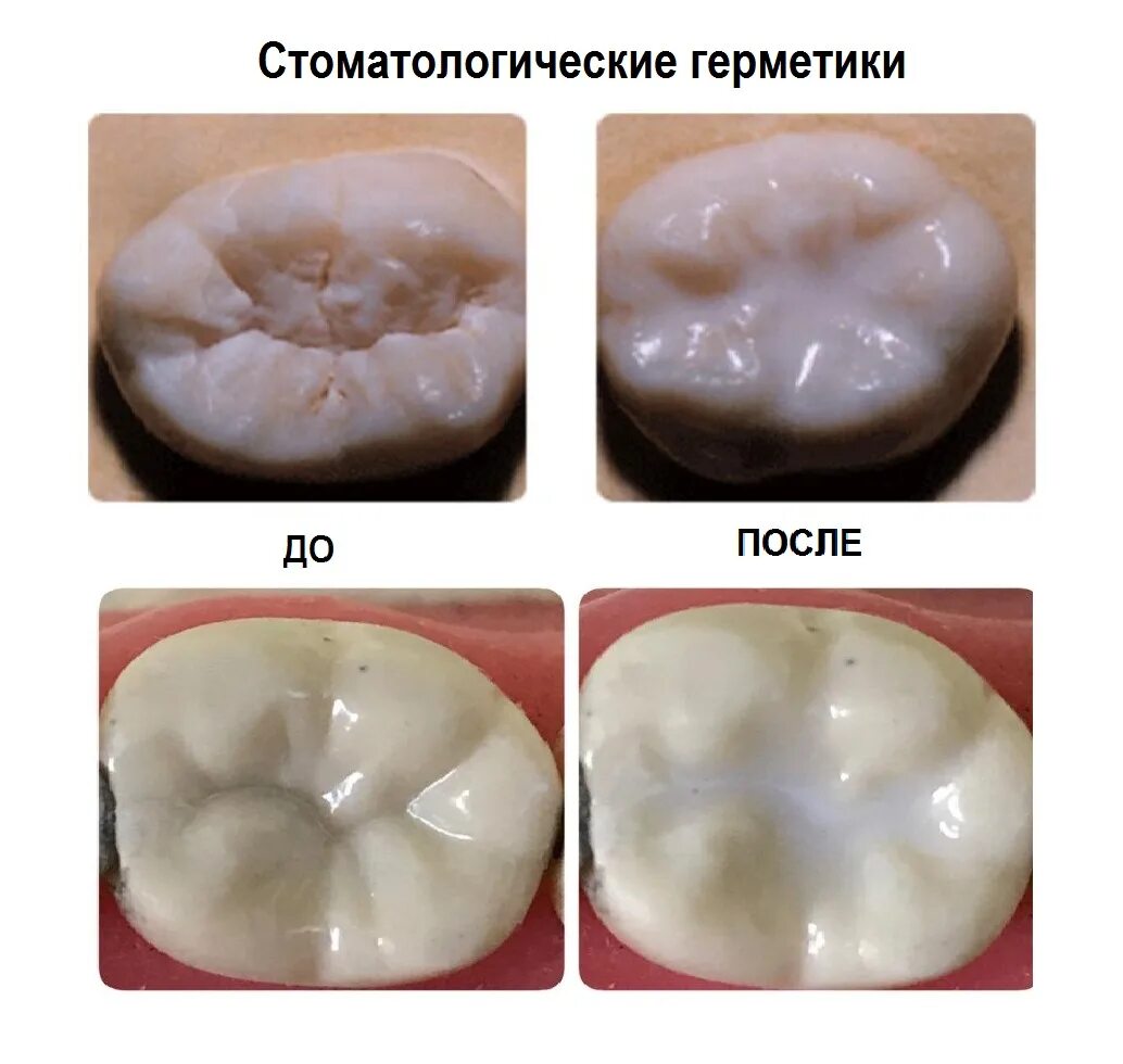 Кариес до и после лечения фото Силанты и герметики в современной стоматологии