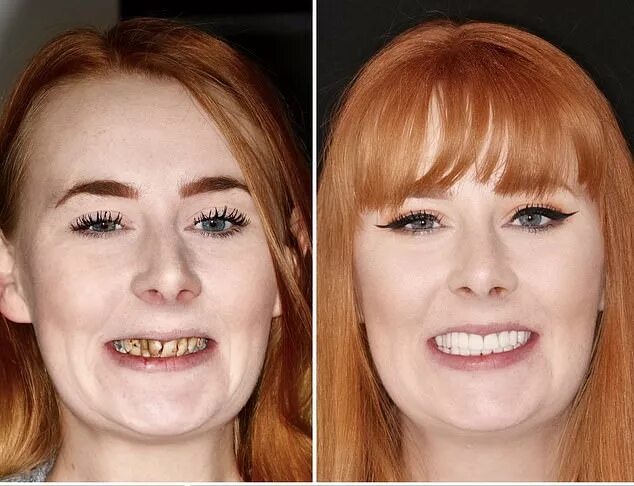 Кариес до и после лечения фото Woman, 26, told she would need full DENTURES to fix her decaying teeth