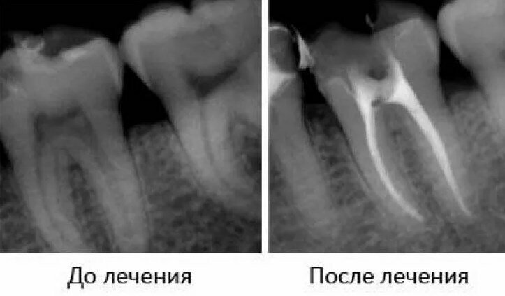 Кариес корня зуба фото Стоматология, dental polyclinic, Michurinsk, Kirsanovskaya ulitsa, 2Б - Yandex M