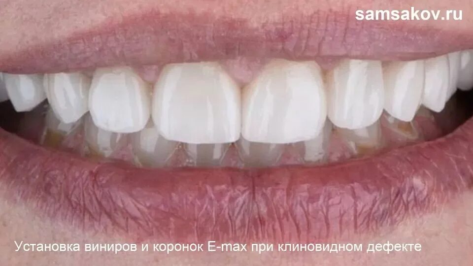 Кариес между передними зубами фото Сроки изготовления и установки лабораторных виниров Альянс бьюти стоматологов, М