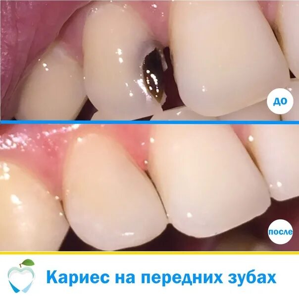 Кариес между передними зубами фото Покрытие от кариеса: найдено 88 картинок