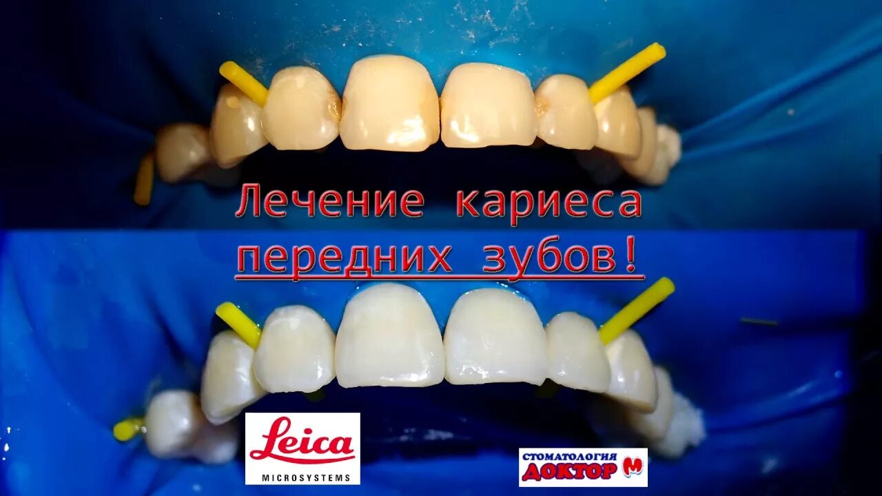Кариес между зубами фото Лечение кариеса передних зубов от первого лица! - YouTube