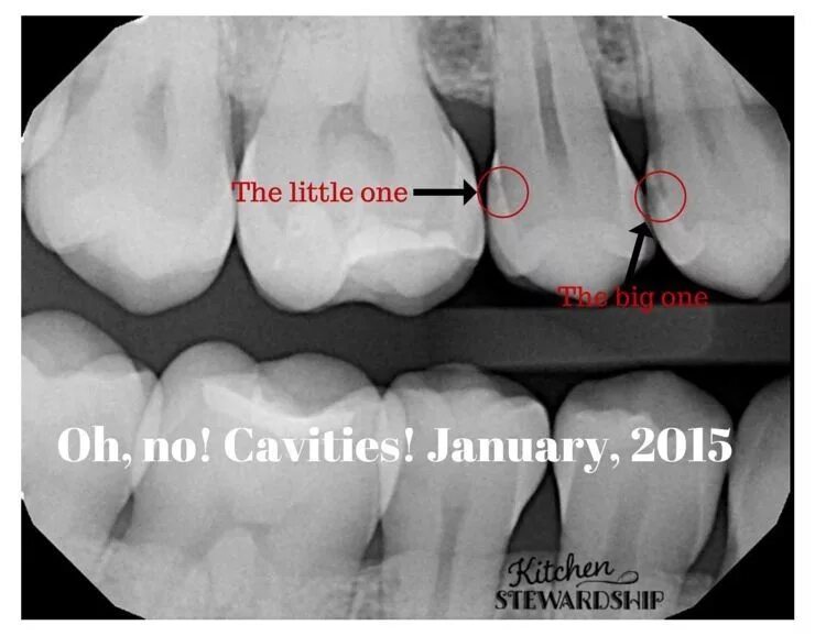 Кариес между зубами как выглядит фото Pin on Dental