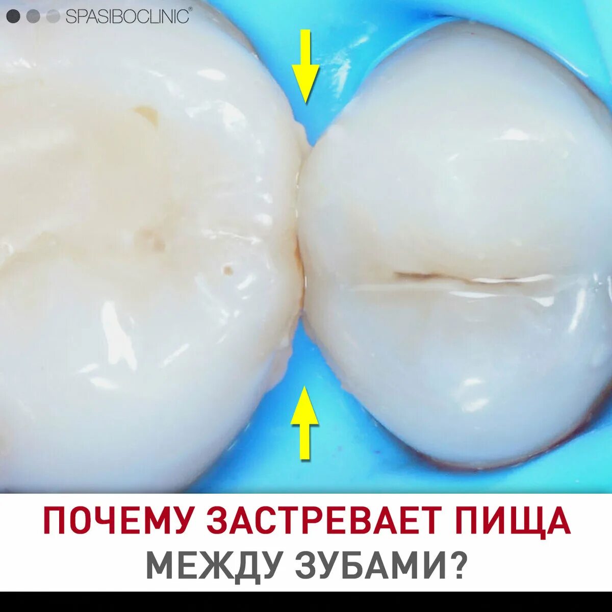 Кариес между зубами как выглядит фото ПОЧЕМУ ЗАСТРЕВАЕТ ПИЩА МЕЖДУ ЗУБАМИ? Спасибо.Клиник Дзен