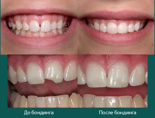 Кариес между зубами как выглядит фото Бондинг в стоматологии Круглосуточная стоматология в Москве