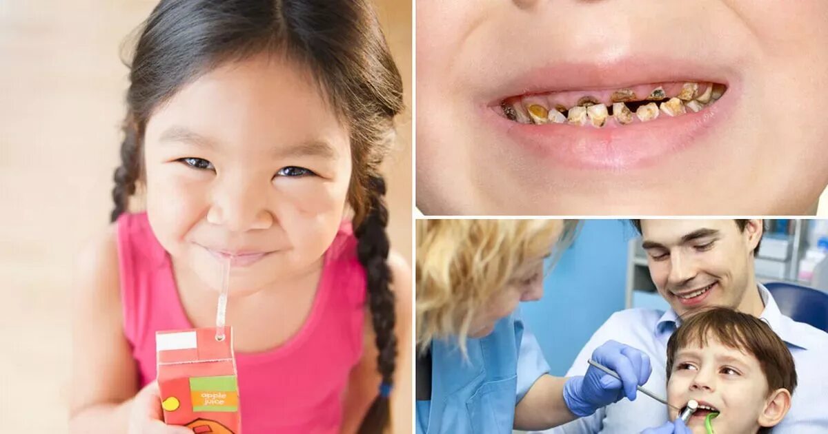 Кариес молочных зубов фото Half of children have tooth decay - with poverty and sugar blamed for epidemic -